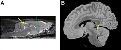 The Inferior Colliculus in Alcoholism and Beyond